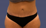 Abdominoplasty (Tummy Tuck) 18 After